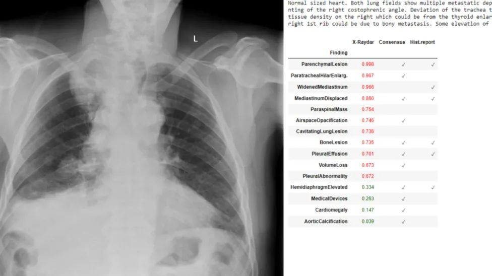인공지능이 진단하는 흉부 X-선, X-raydar 프로젝트 image 1